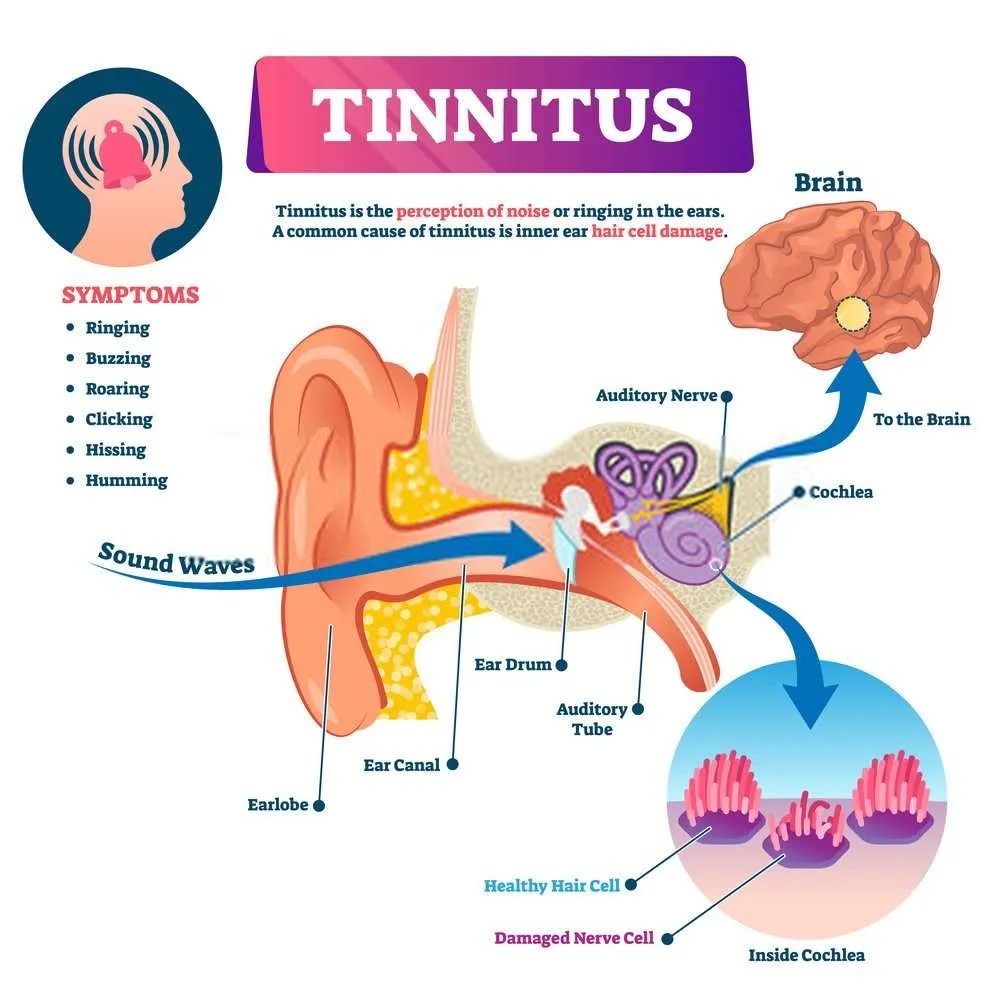 General Fuzz Tinnitus Best Treatment For Tinnitus in 2021