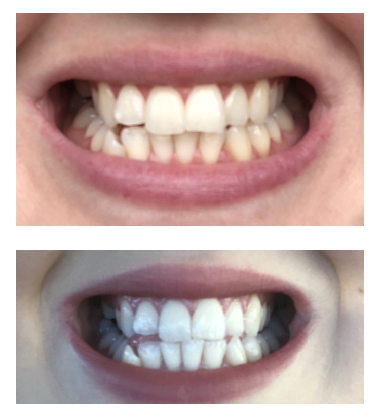 Review HiSmile Why Hello Beauty