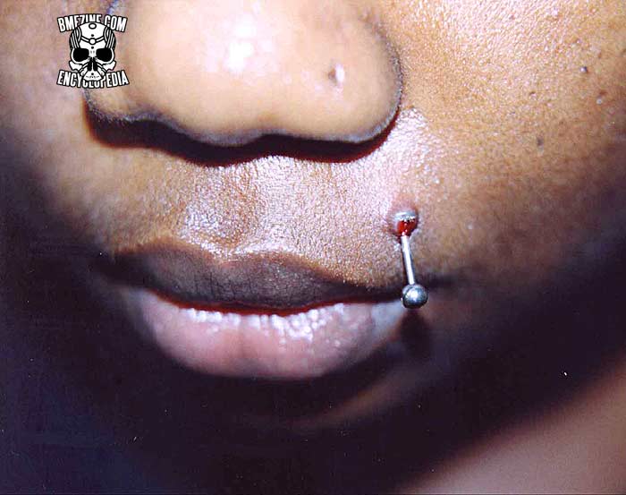FileEmbedded Labret1.jpg BME Encyclopedia