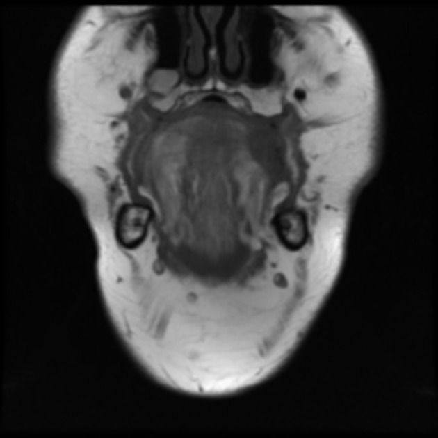 Tongue cancer MRI wikidoc