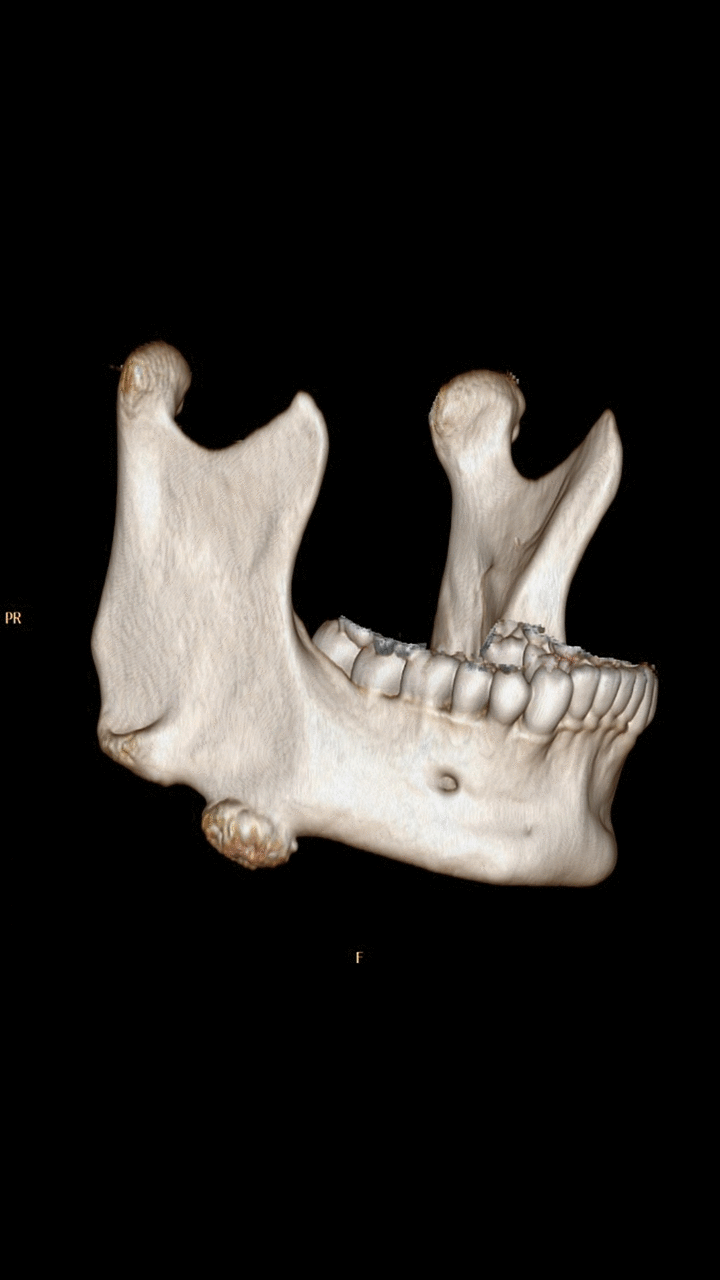 Osteoma wikidoc