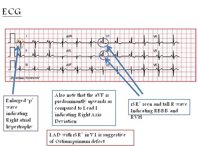 Atrial septal defect electrocardiogram - wikidoc