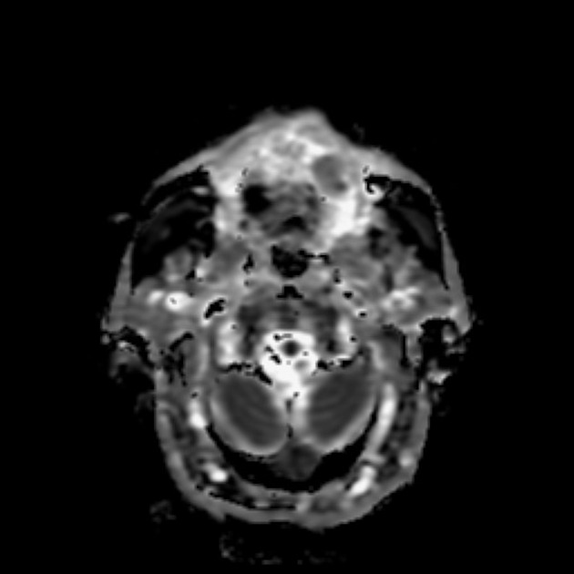 Tongue cancer MRI wikidoc