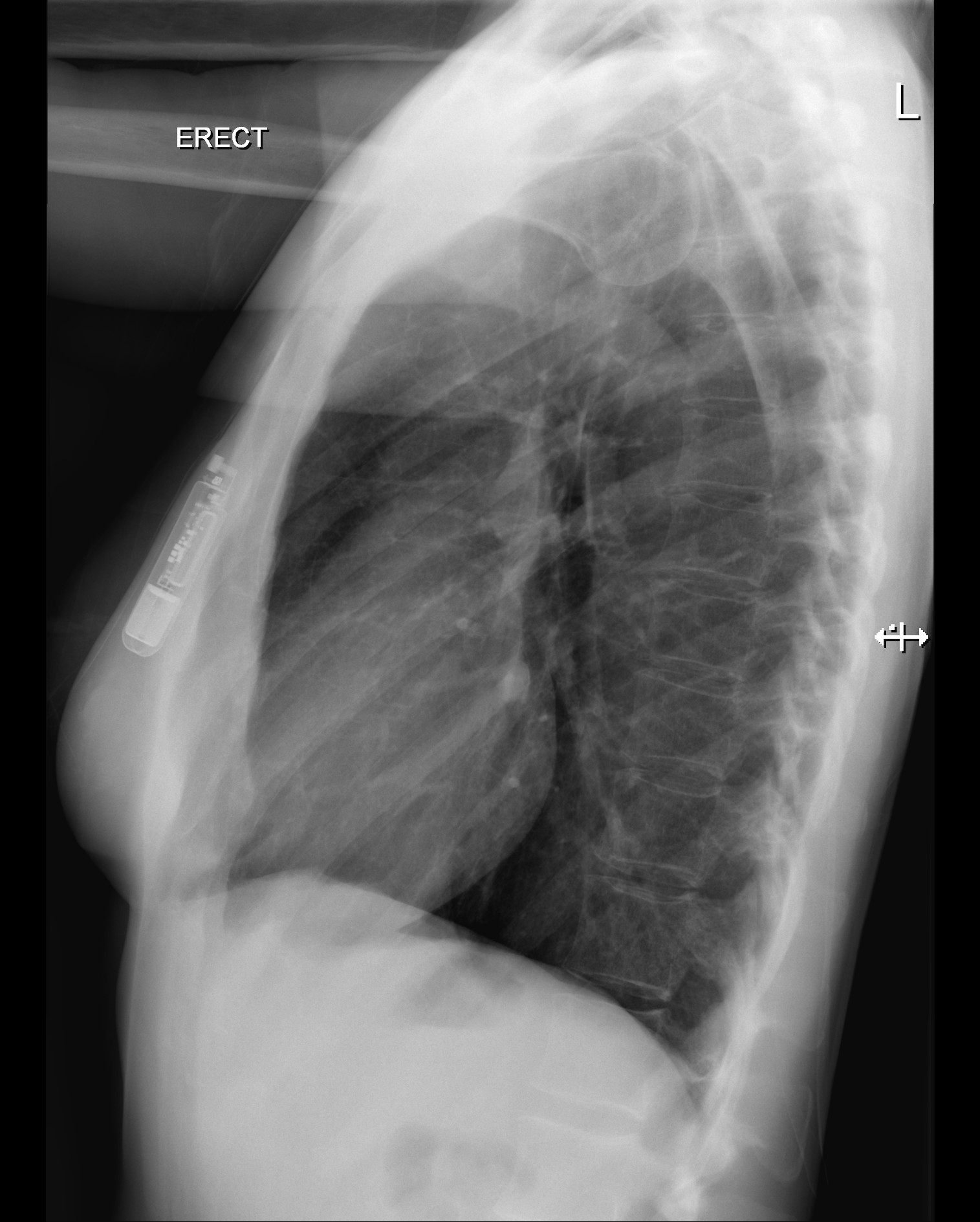 Syncope x ray wikidoc