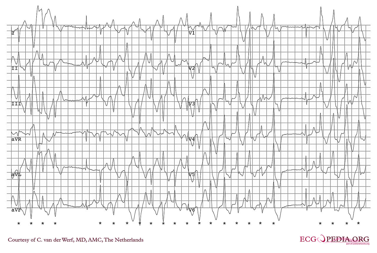 Ventricular tachycardia classification wikidoc