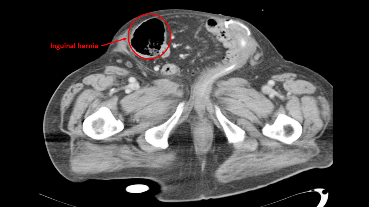 Inguinal hernia CT wikidoc