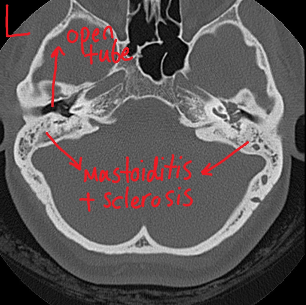 Mastoiditis CT wikidoc