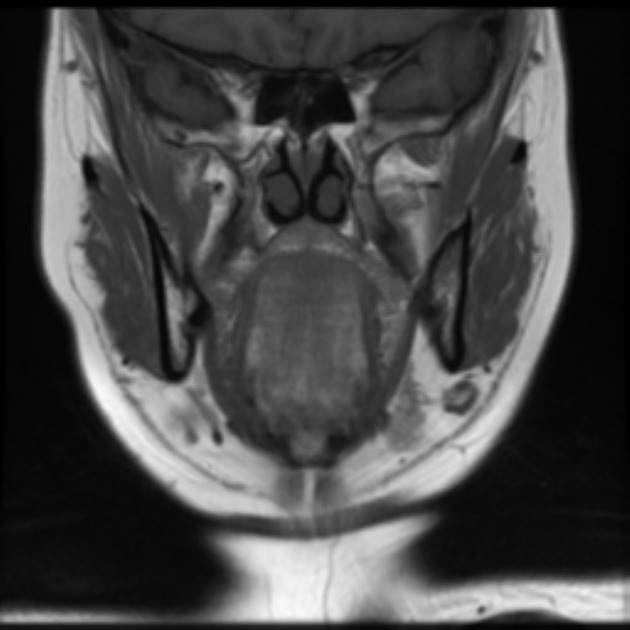 Tongue cancer MRI wikidoc