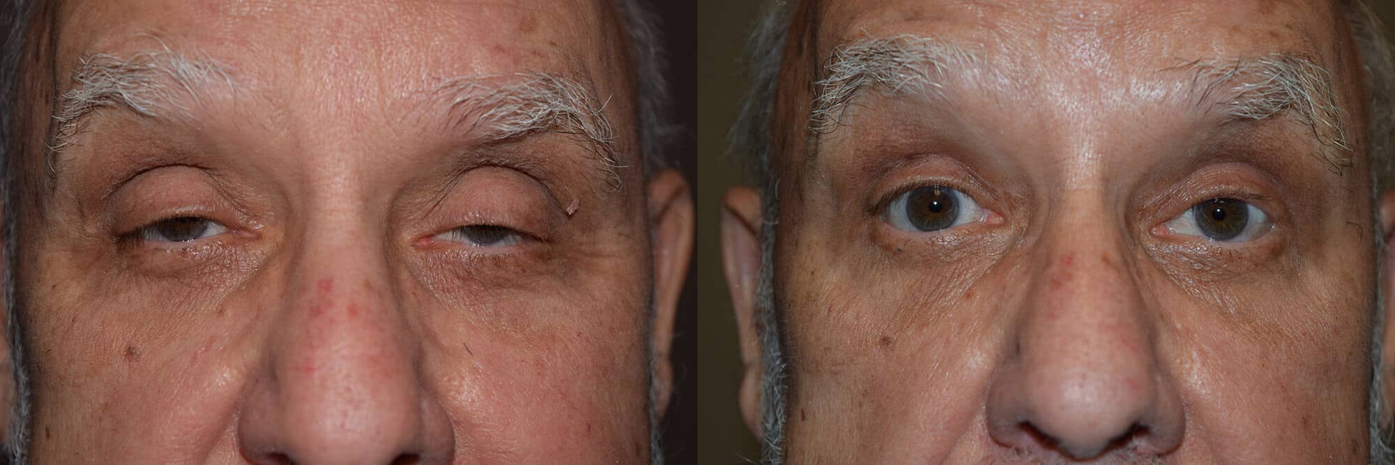 Facial Cosmetic Surgery Little Rock, AR Before & After Gallery