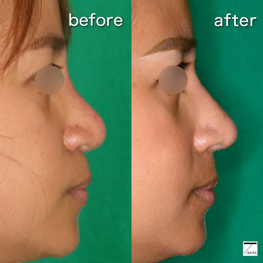 曲がった鼻の悩みやご相談｜鼻の整形なら大塚美容形成外科 ・歯科 鼻詰まりと曲がりは同時に治せる？治療の３大ポイントを図で理解する | 新さっぽろウィメンズ ヘルス&ビューティークリニック