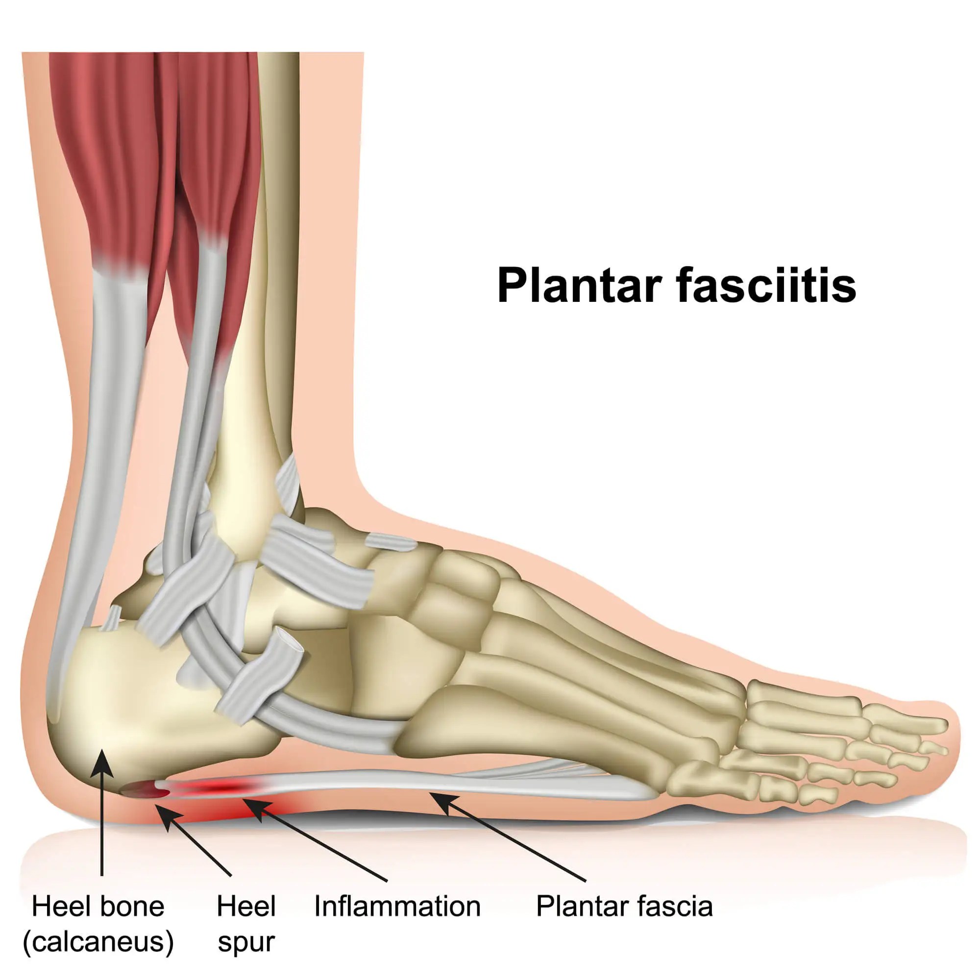 Electrical Stimulation For Plantar Fasciitis How It Works