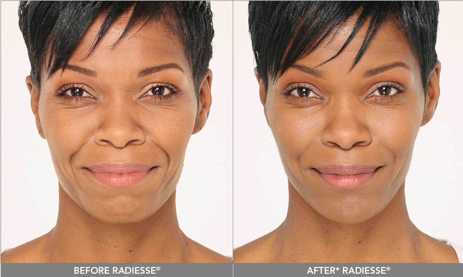 Radiesse Dermal Filler Volume Replacement Willo MediSpa