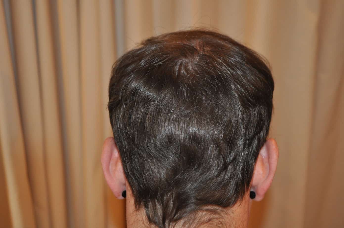 How Much Does A Crown Hair Transplant Cost?