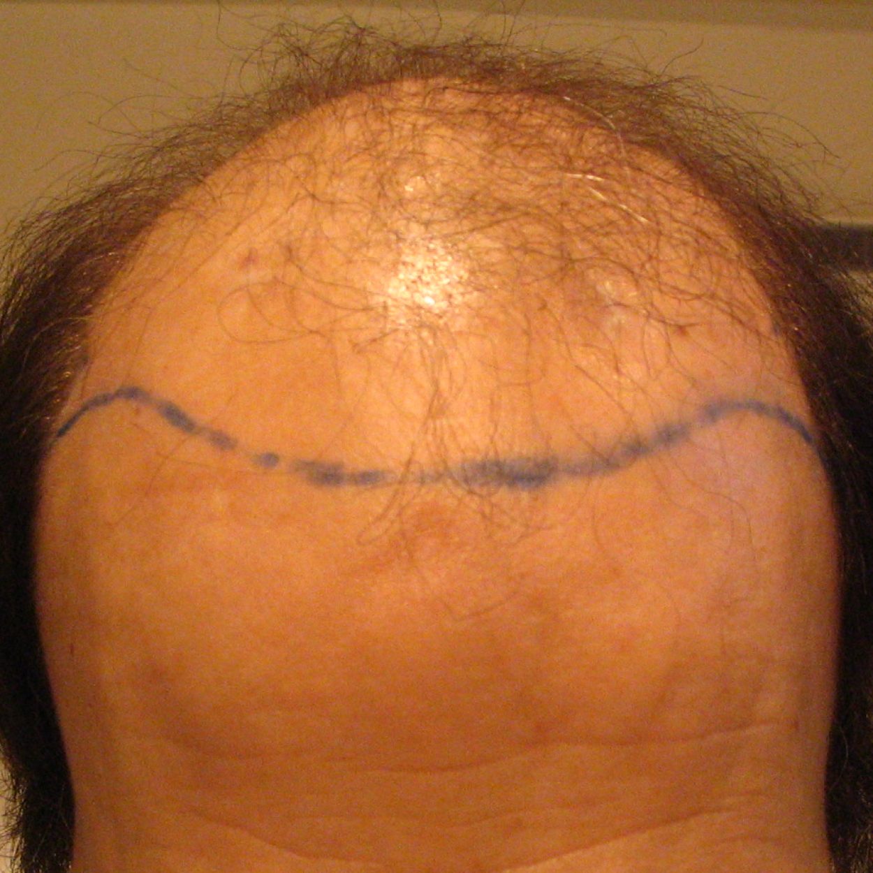 5000 Graft Hair Transplant Coverage, Costs, Results