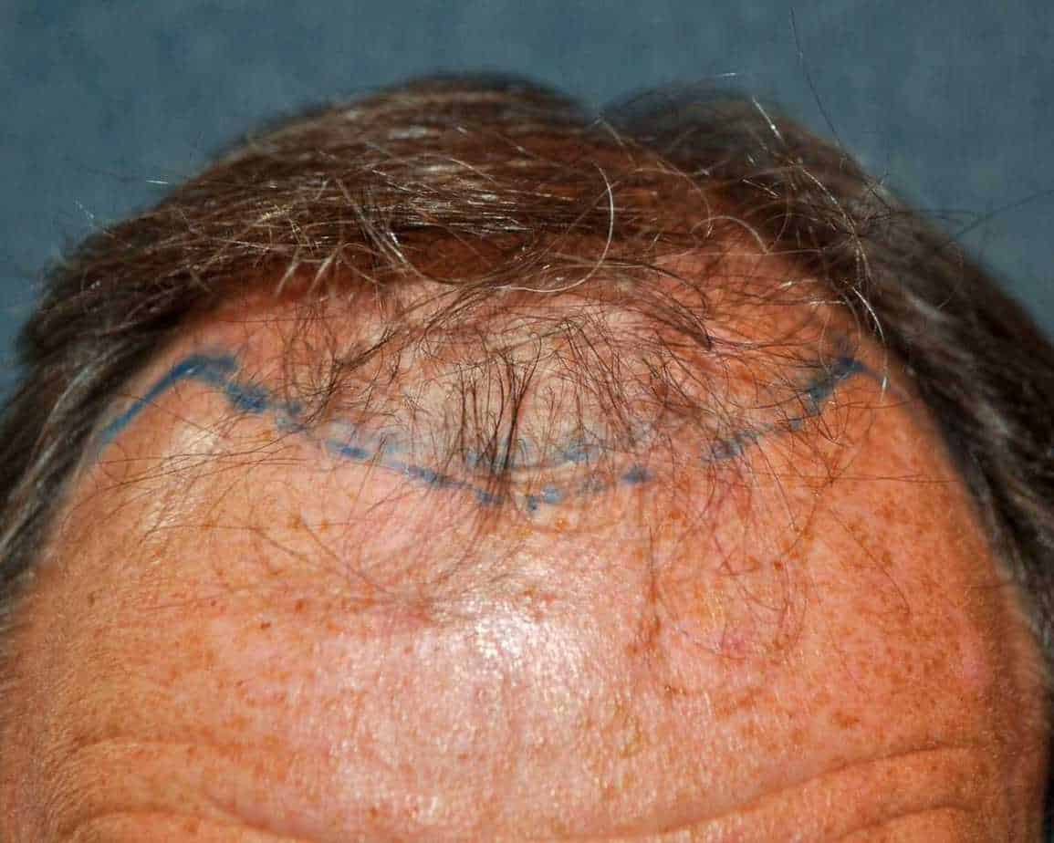 Hair Transplant Falling Out After 1 Year What To Do Next