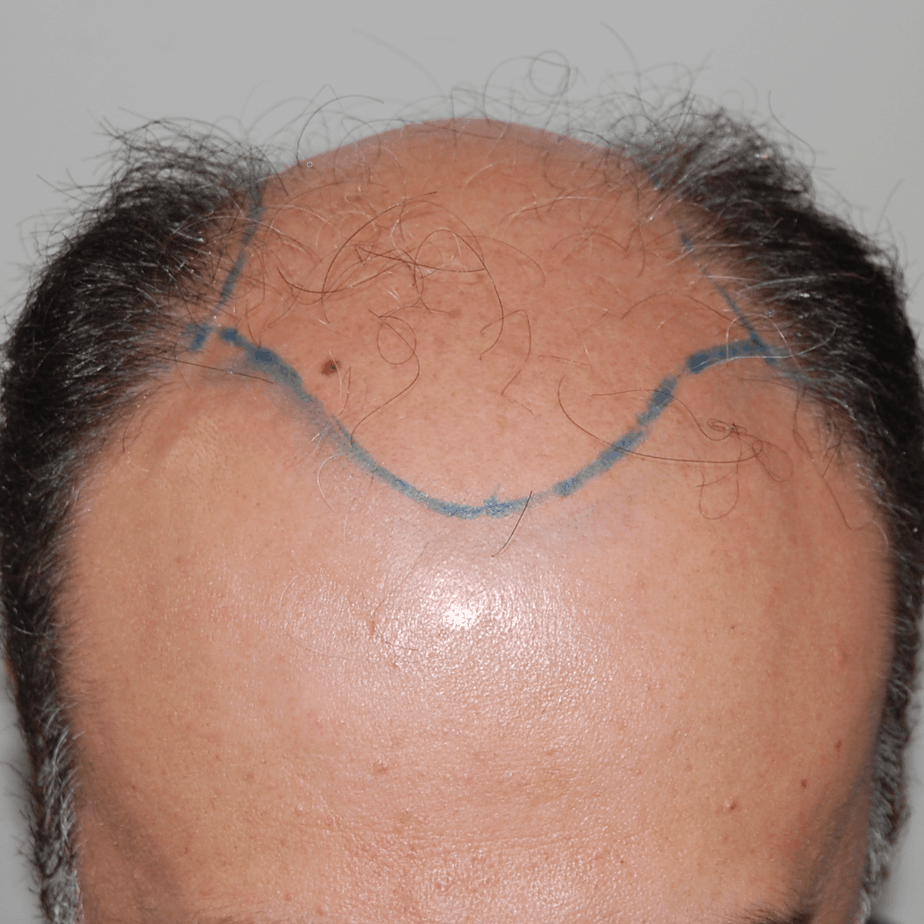 Norwood Stage 6 Photos, Treatments, Results Wimpole Clinic