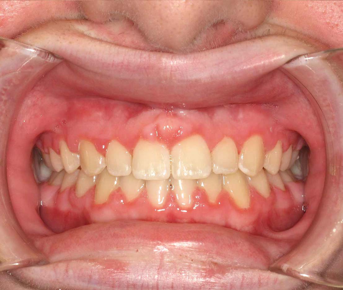 Orthodontic Smile Makeover in Atlanta, GA Quality Care from