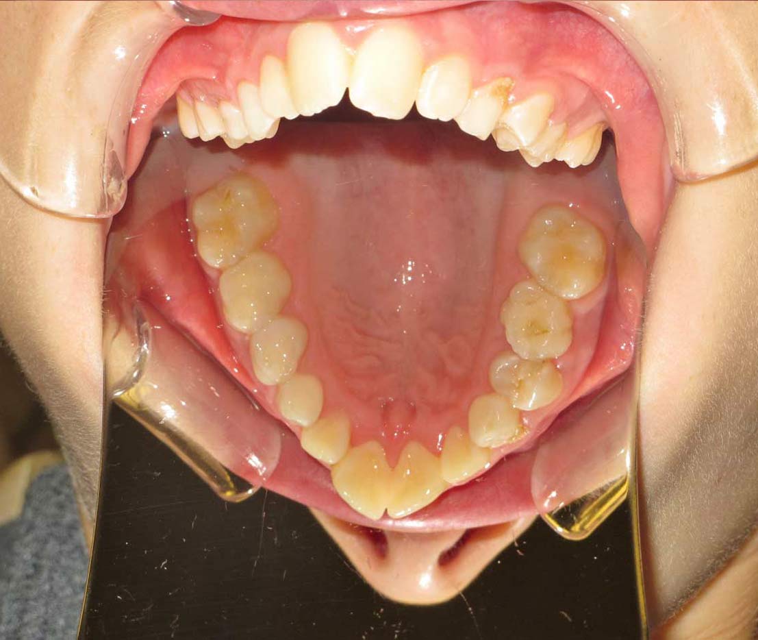 Orthodontic Smile Makeover in Atlanta, GA Quality Care from