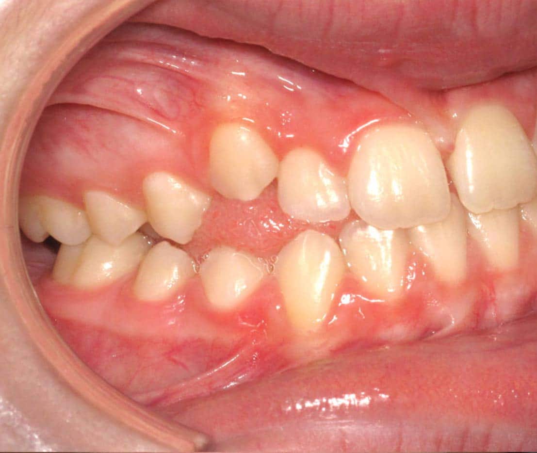 Orthodontic Smile Makeover in Atlanta, GA Quality Care from