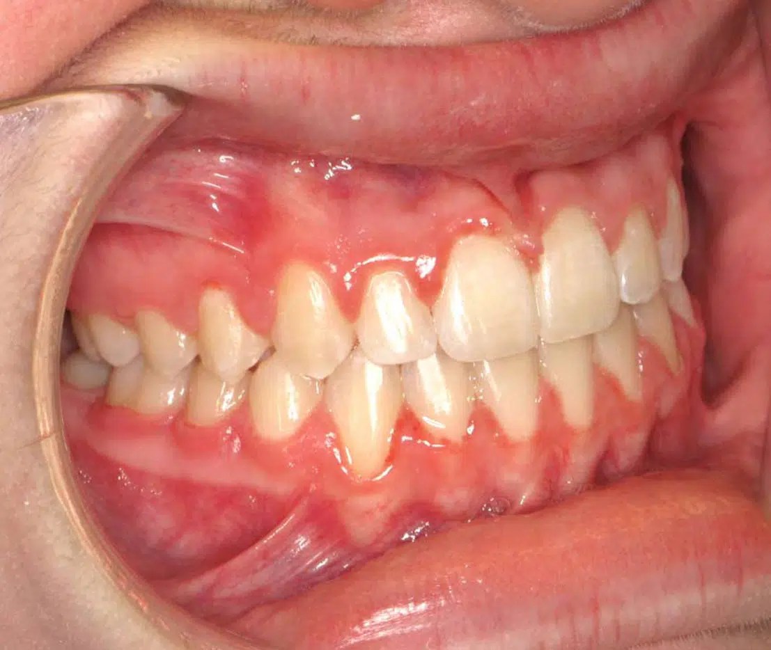 Orthodontic Smile Makeover in Atlanta, GA Quality Care from