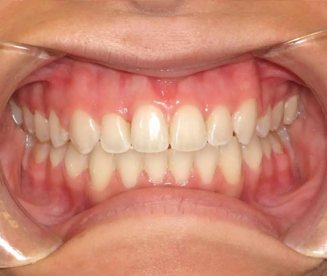 Orthodontic Smile Makeover in Atlanta, GA Quality Care from