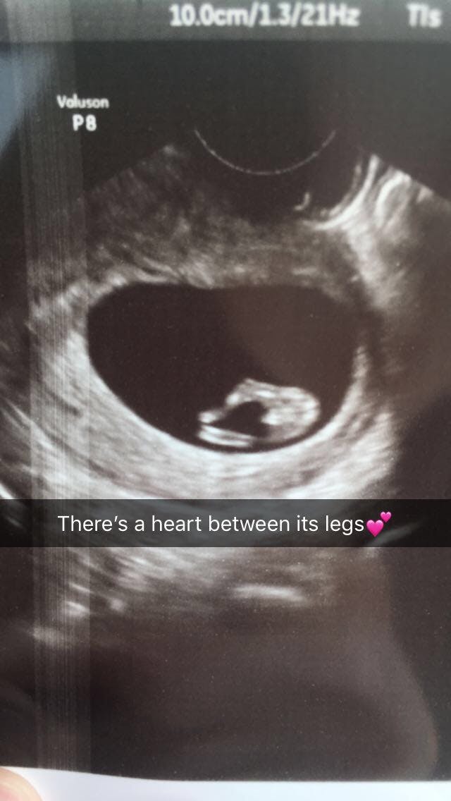 10 week ultrasound Winnie