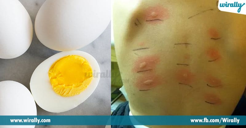 6 Things You Need To Know About Food Allergies Wirally