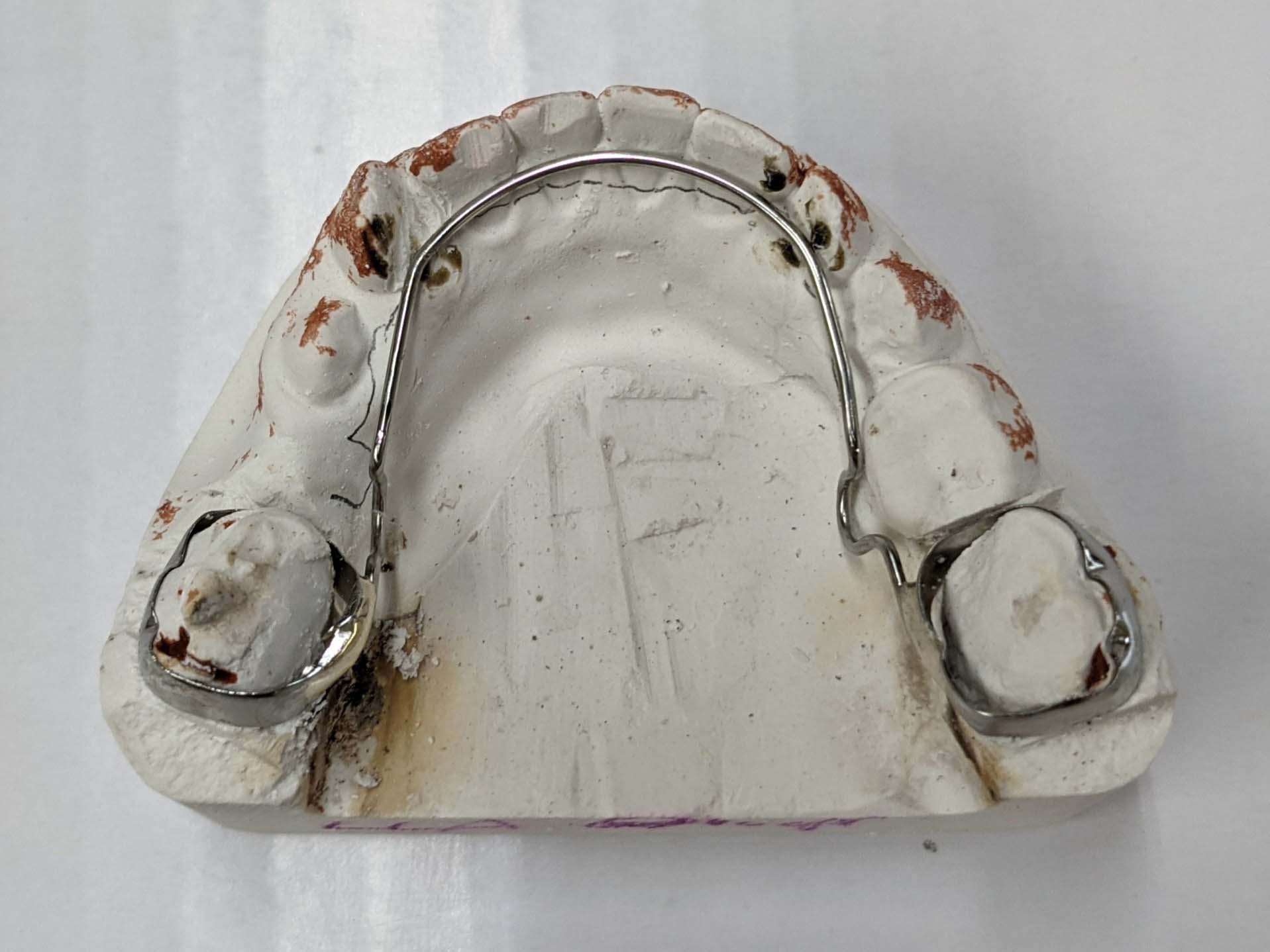 Space Maintainers, Distal Shoe Appliances in Evansville, IN Wired