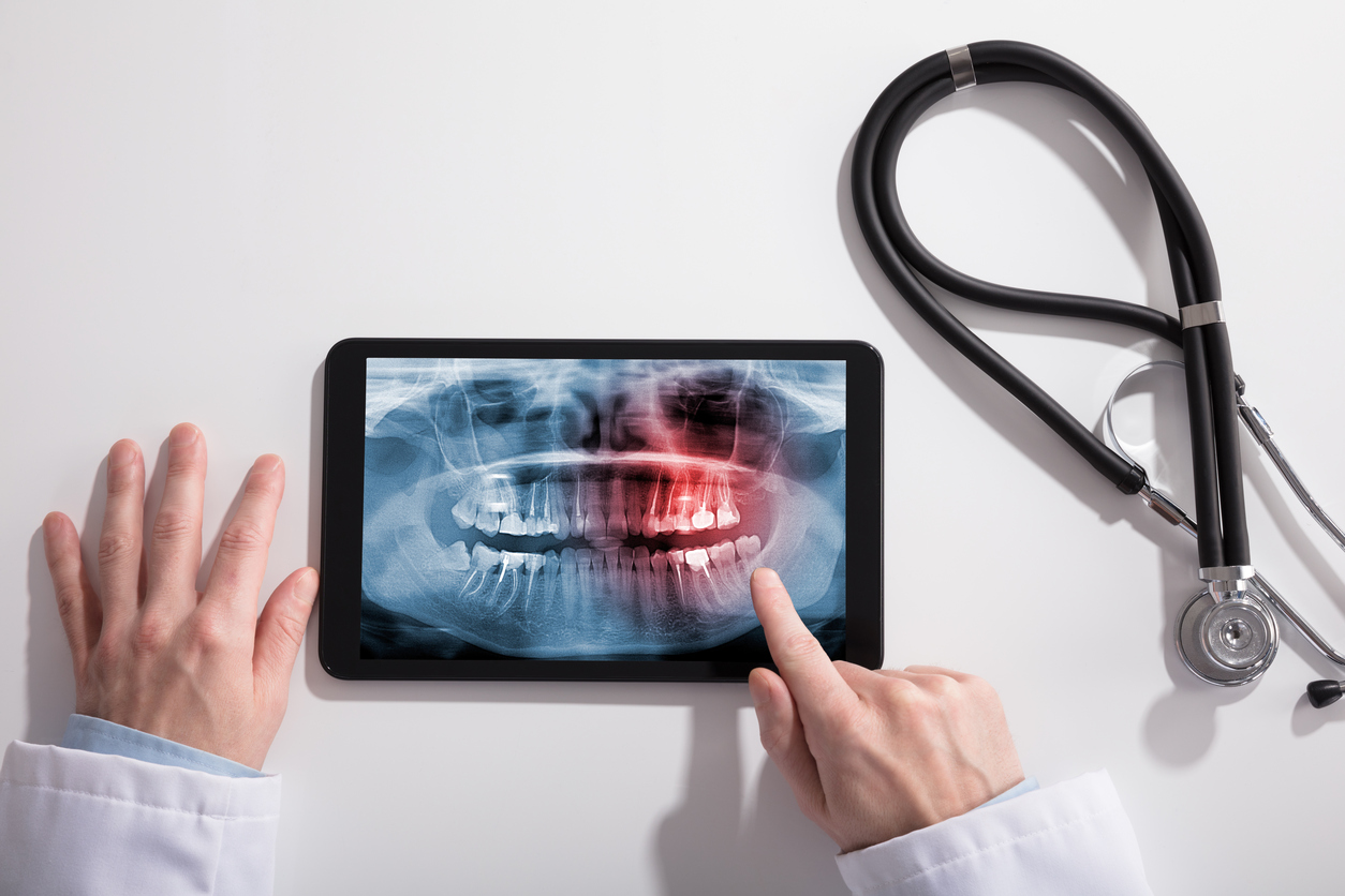 Impacted Wisdom Teeth Causes Of Tooth Removal