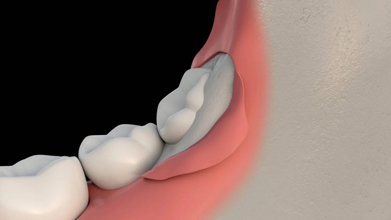 Wisdom Teeth Removal Surgery A Complete Guide Wisdom Teeth Factory
