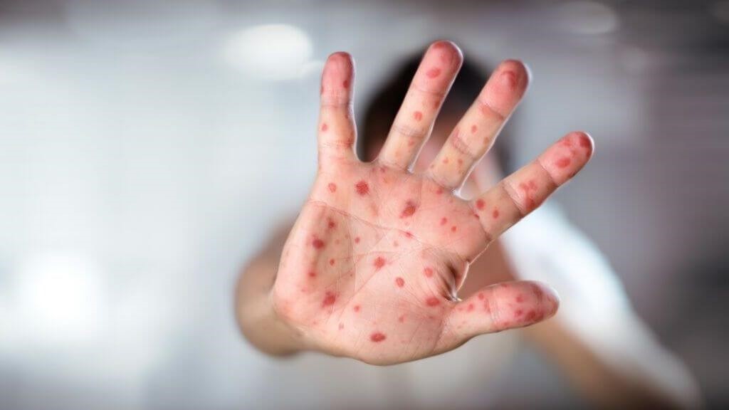 Causes of Skin Rash Wisteria