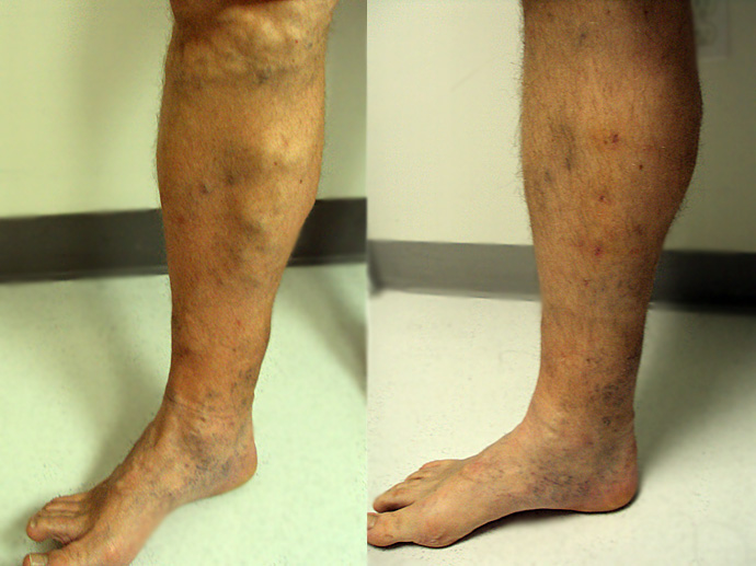 61+ [ Peyronie Before And After ] Mild Peyronies Disease, Gum