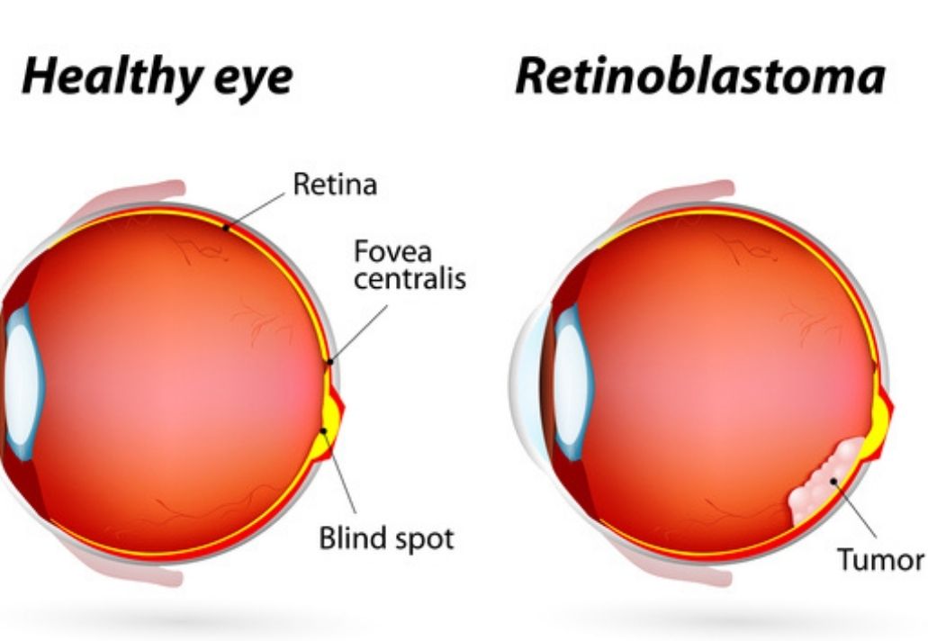 Check Out Signs, Symptoms Of Retinoblastoma In Kids! Woman's era