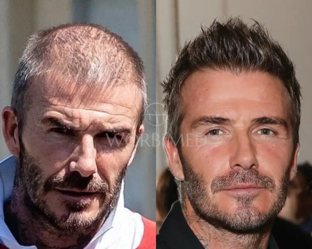 David Beckham Hair Transplant Before and After