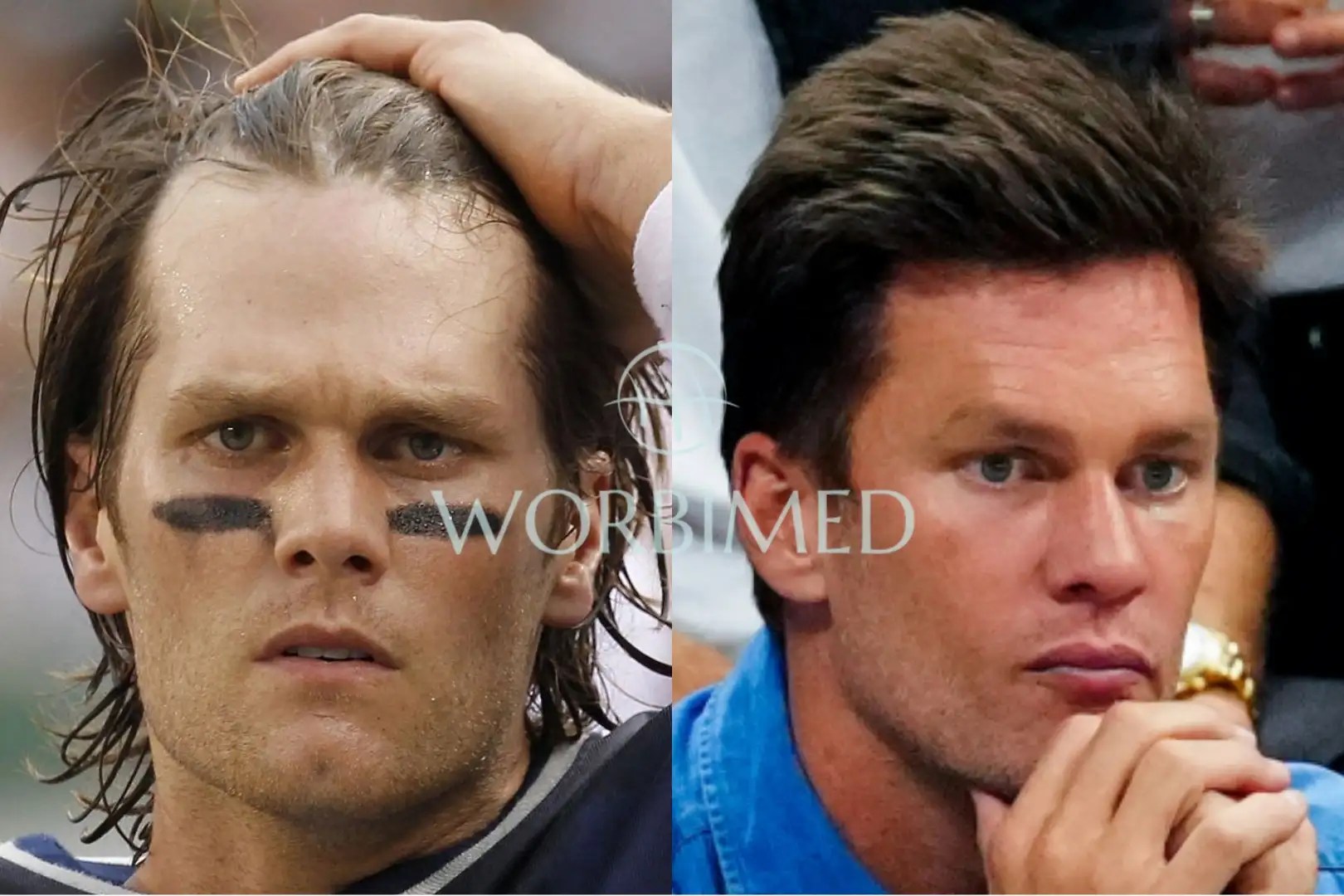 Tom Brady Hair Transplant l Before and After