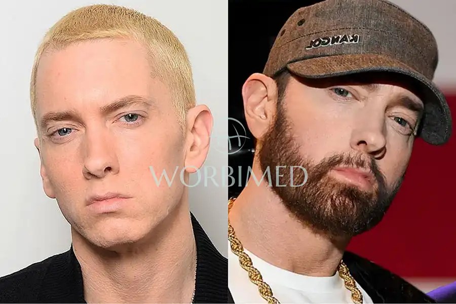 Eminem Sober Before And After