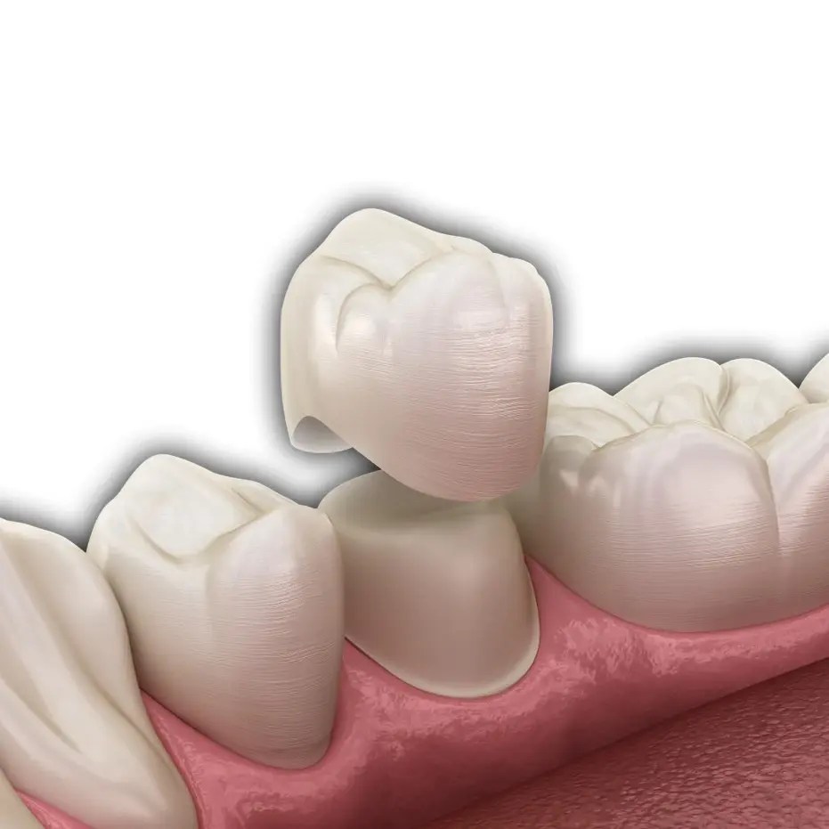 SameDay Crowns Worcester, MA Worcester Cosmetic & Restorative Dentistry