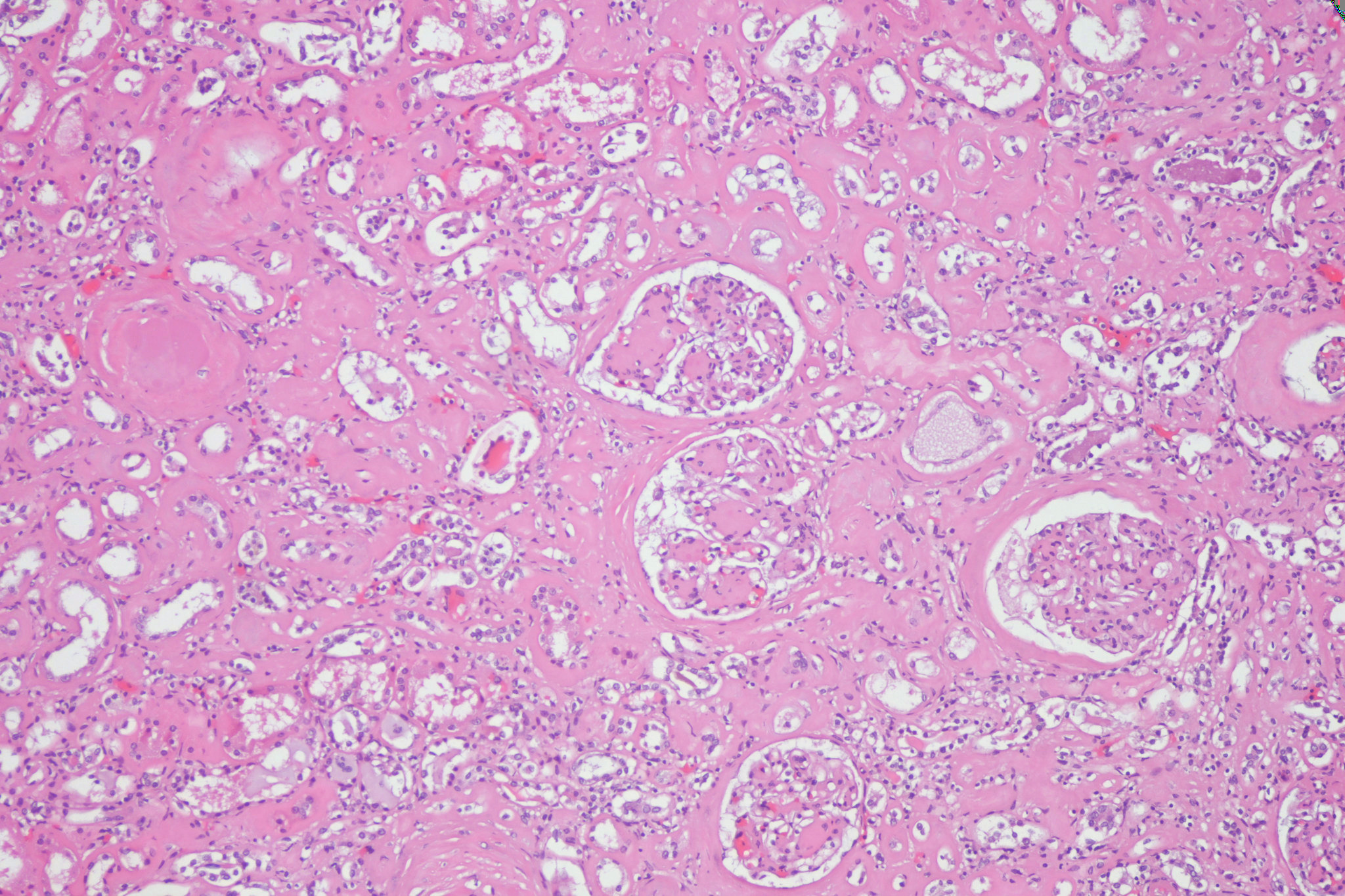 Pathology cases KimmelstielWilson nodules in diabetic nephropathy