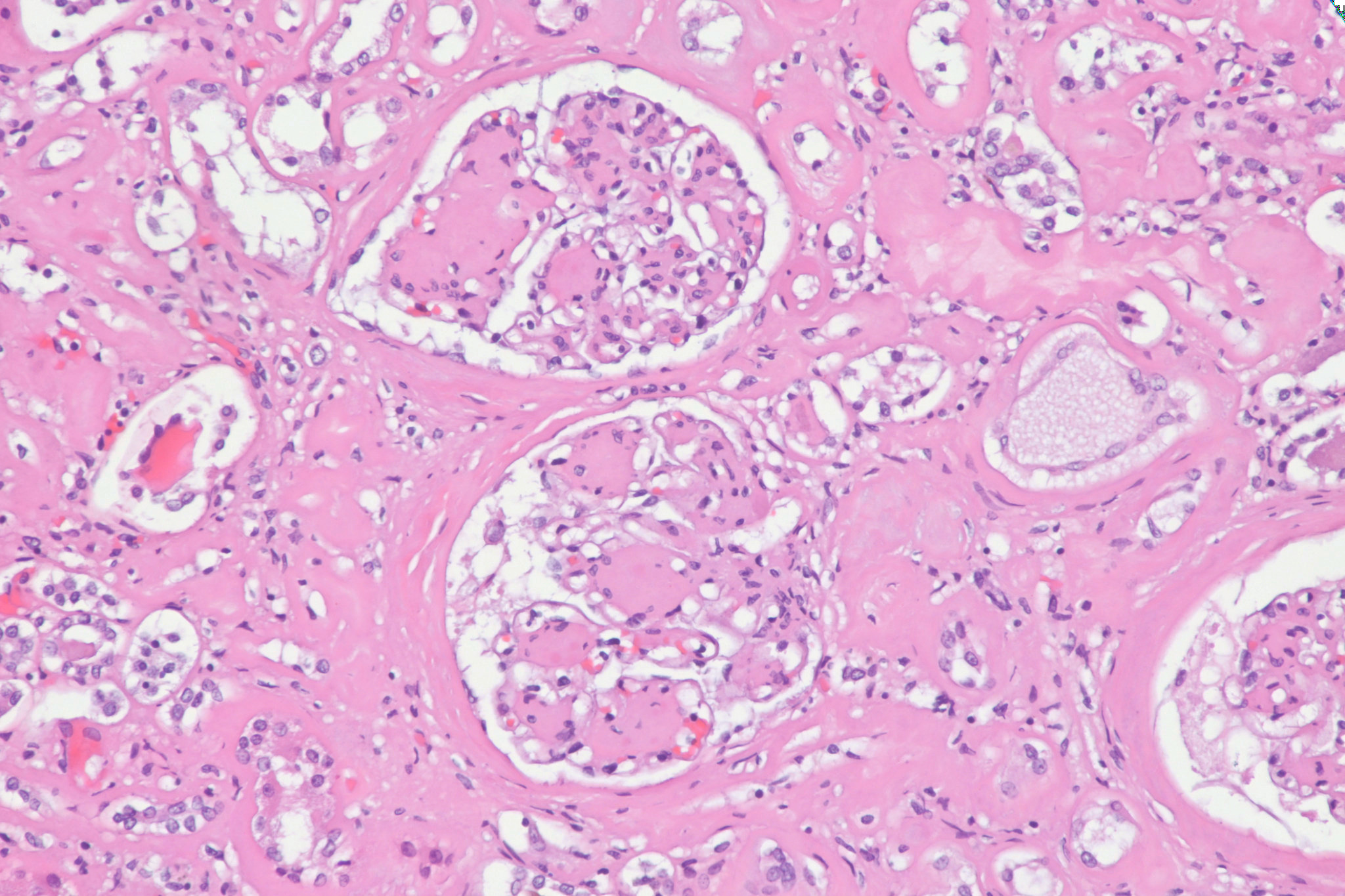 Pathology cases KimmelstielWilson nodules in diabetic nephropathy