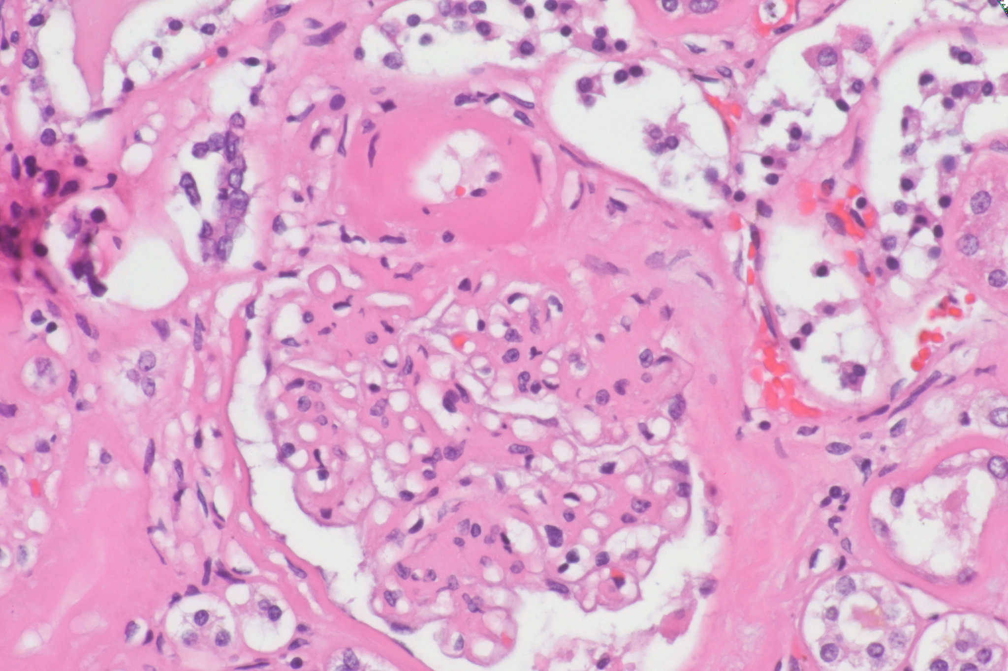 Pathology cases KimmelstielWilson nodules in diabetic nephropathy
