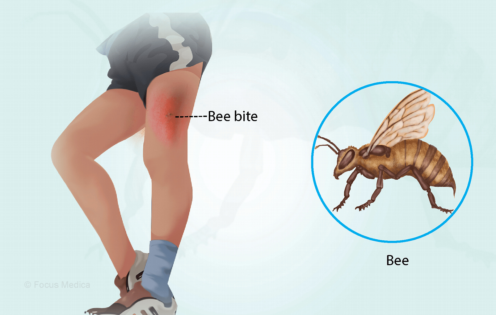 Bee Sting Diagnosis and Treatment