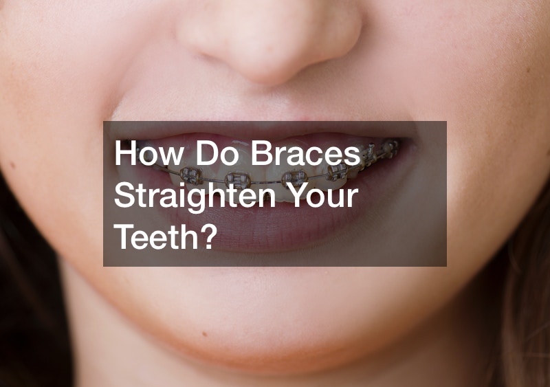 How Do Braces Straighten Your Teeth? Work Flow Management