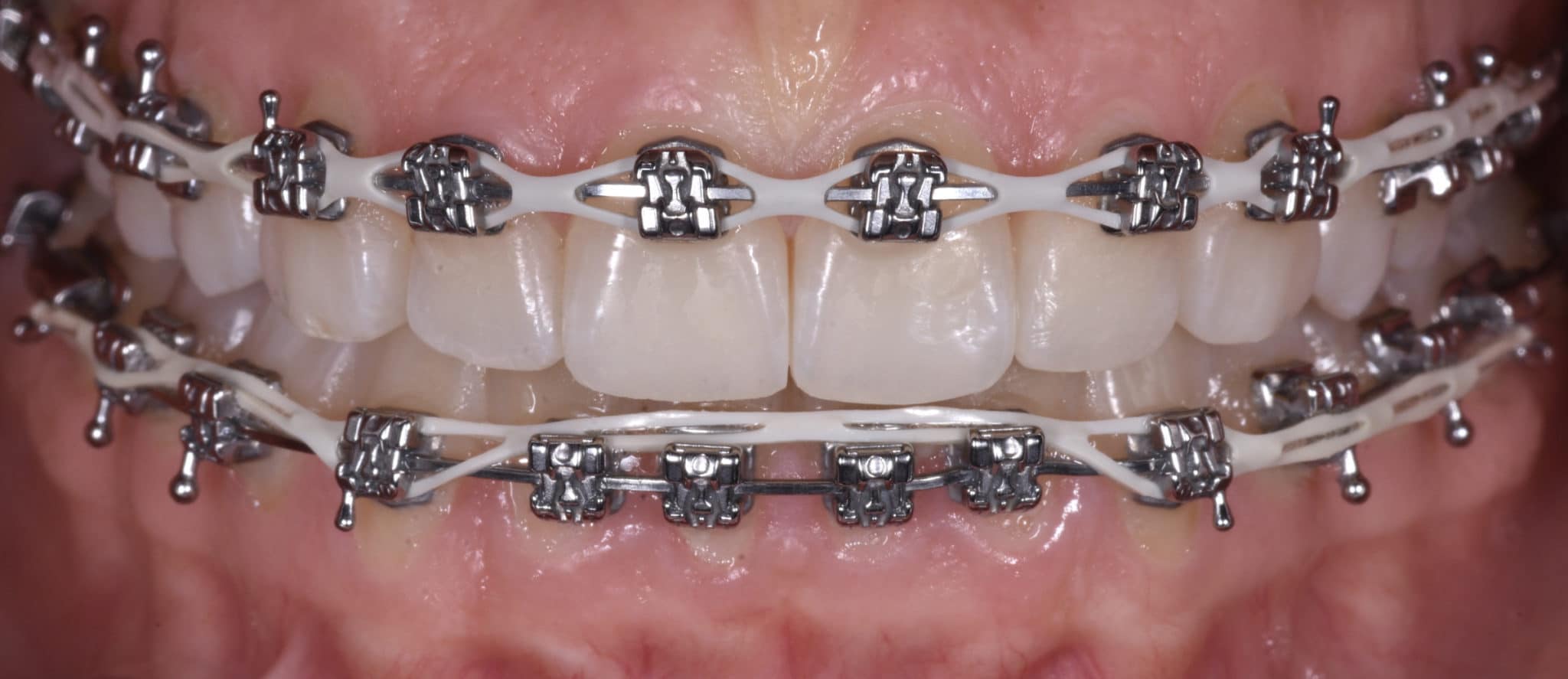 Mordida cruzada unilateral World Orthodontics