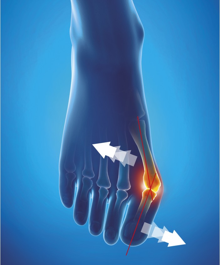 Bunion Night Corrector Epitact