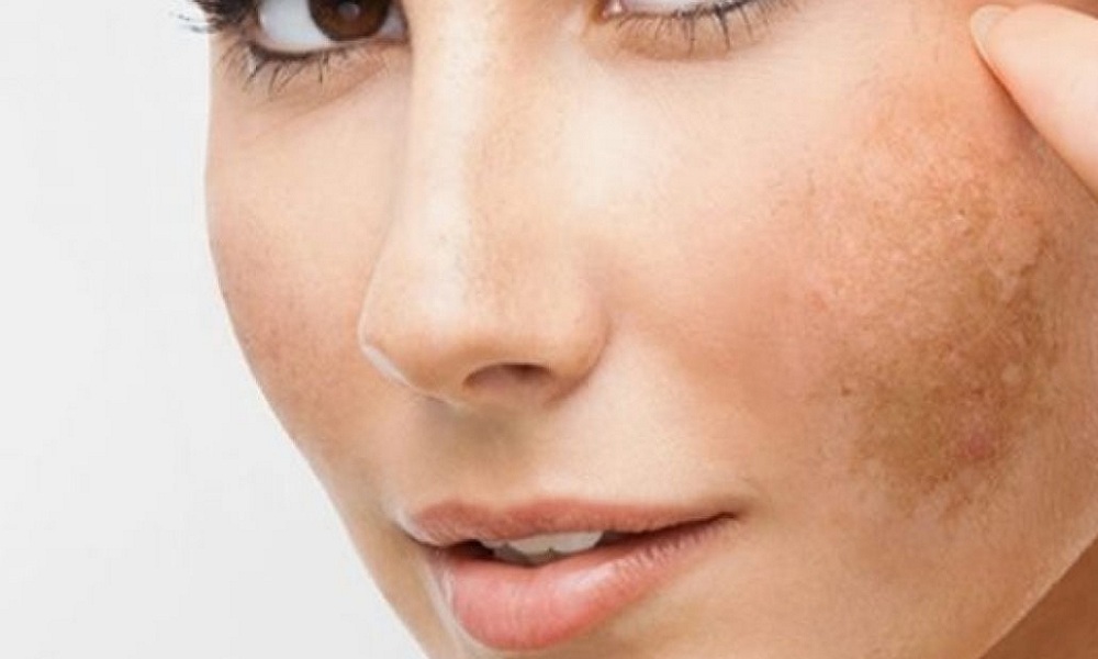 5 Effective Home Remedies for Dark Patches On The Skin (Melasma