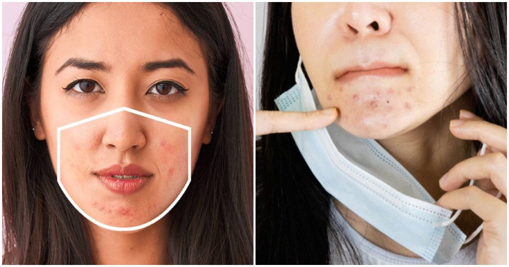 Getting 'Maskne' From Wearing Masks All Day? These Tips Will Help You