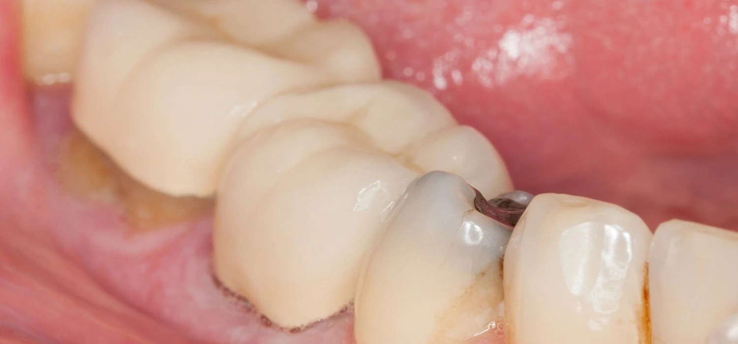 Cavities Under Dental Crowns Signs and Symptoms To Look For