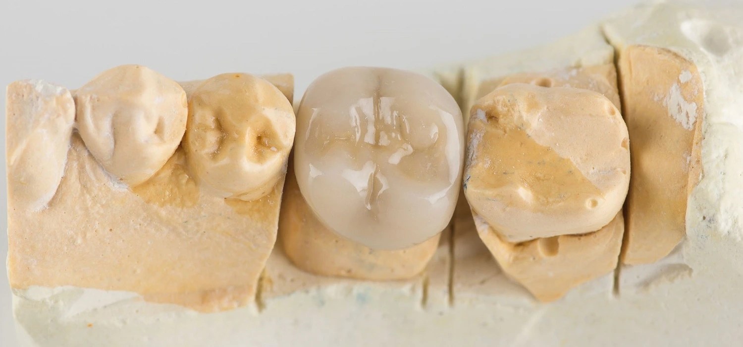 Cavities Under Dental Crowns Signs and Symptoms To Look For