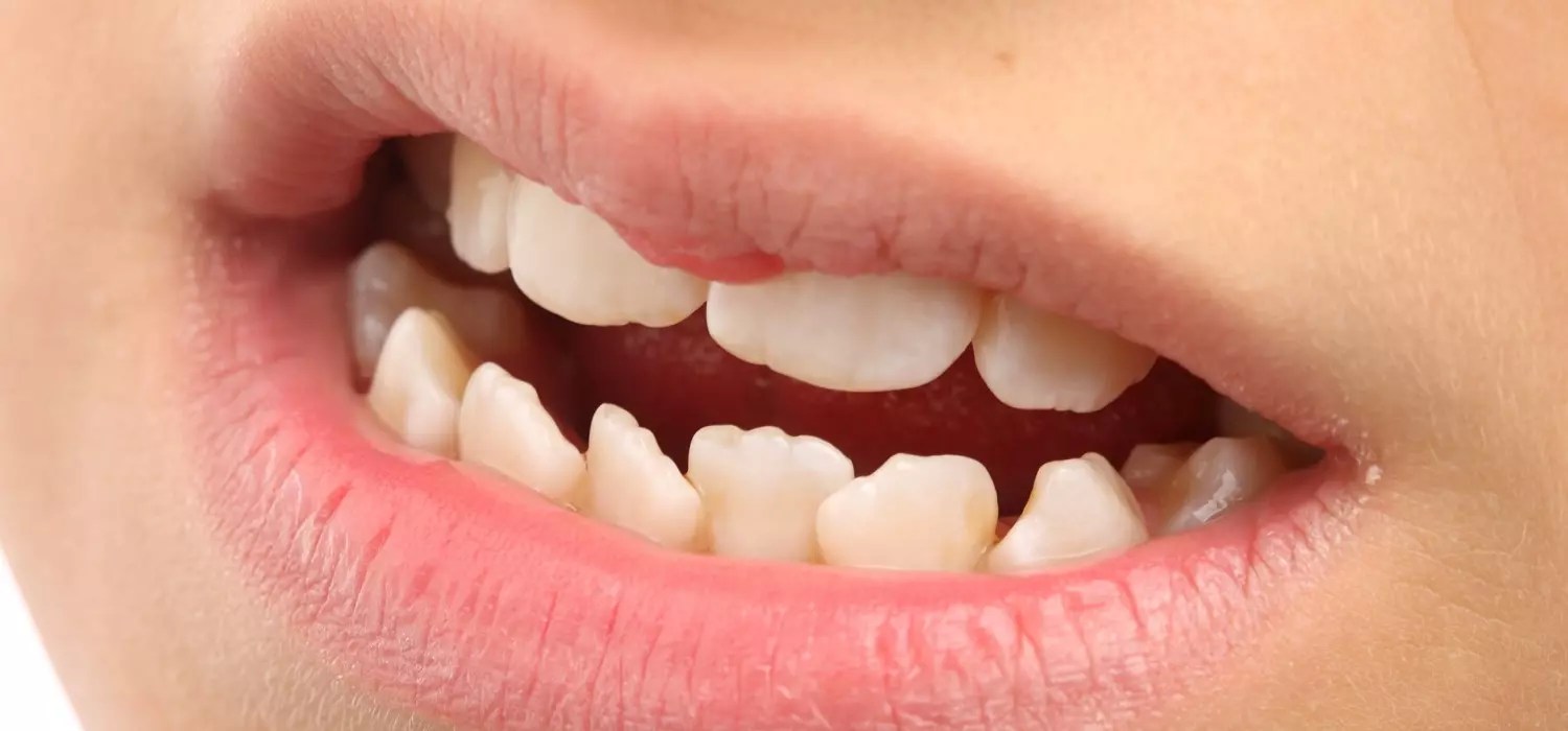 Internal Tooth Resorption 7 Definitive Symptoms To Look For