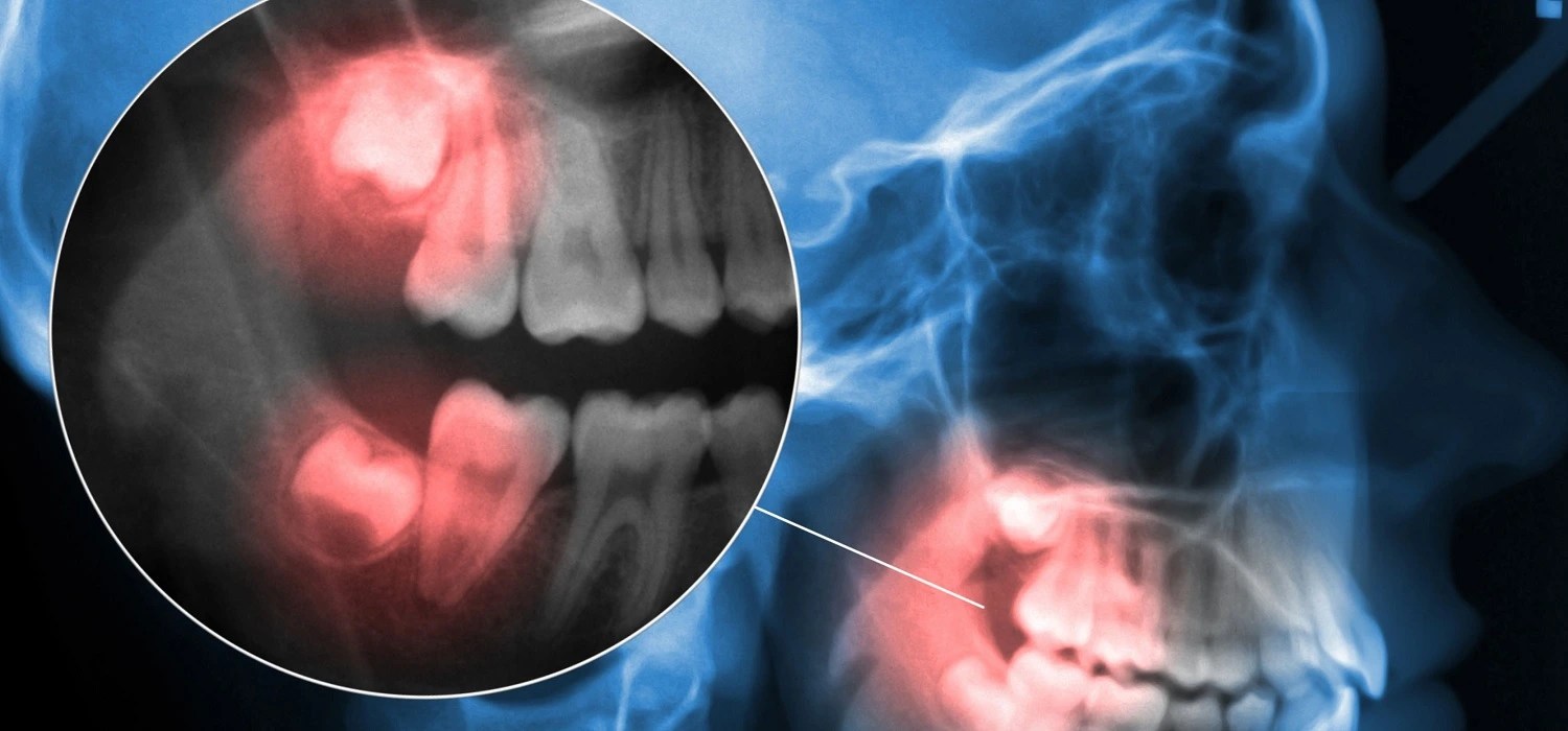 Tooth Infection Spreading to the Bone 6 Definitive Causes